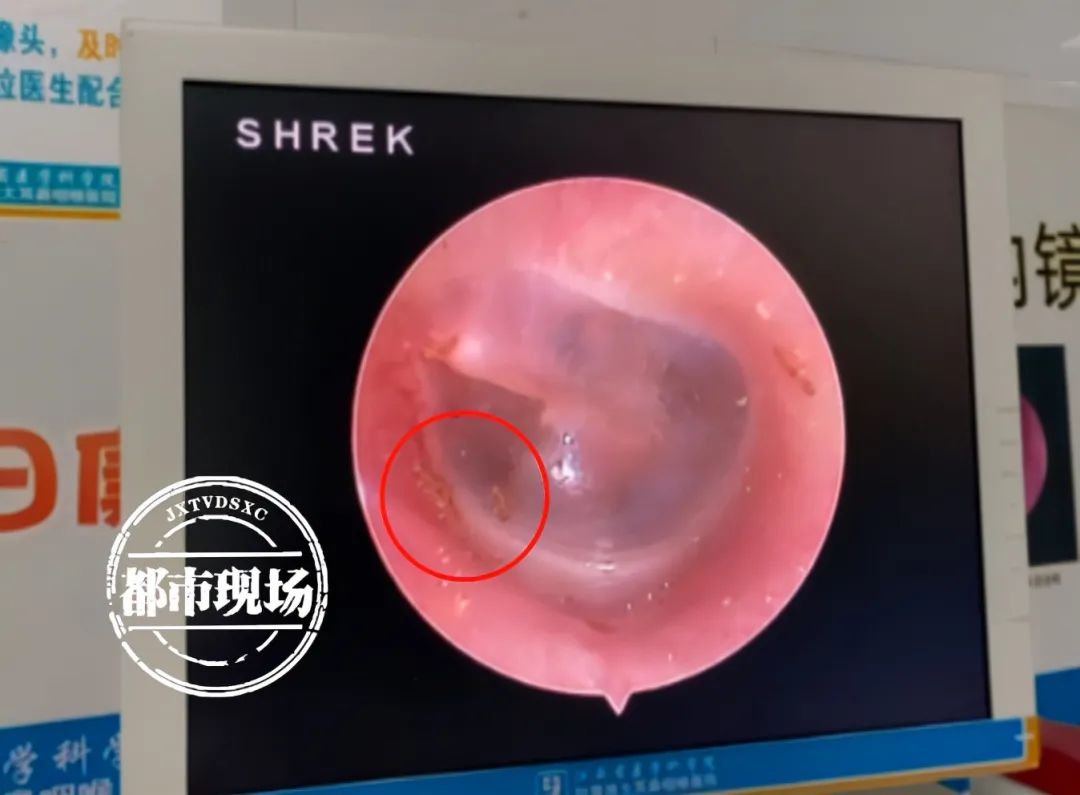 耳朵里发现好几只虫,发现时还在爬!