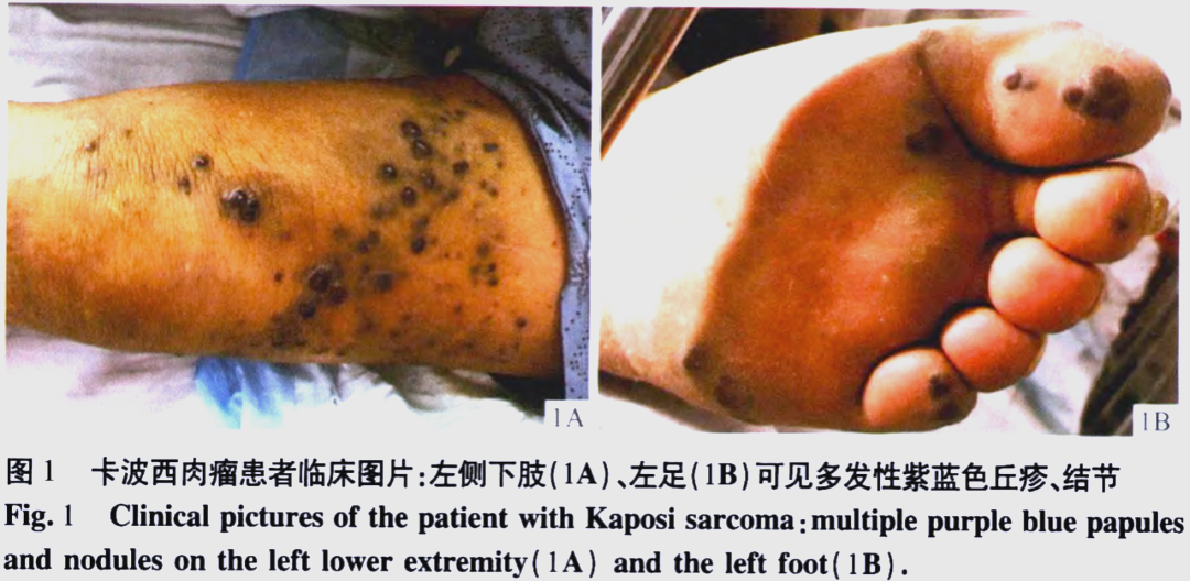 卡波西肉瘤的详细解析与治疗方法