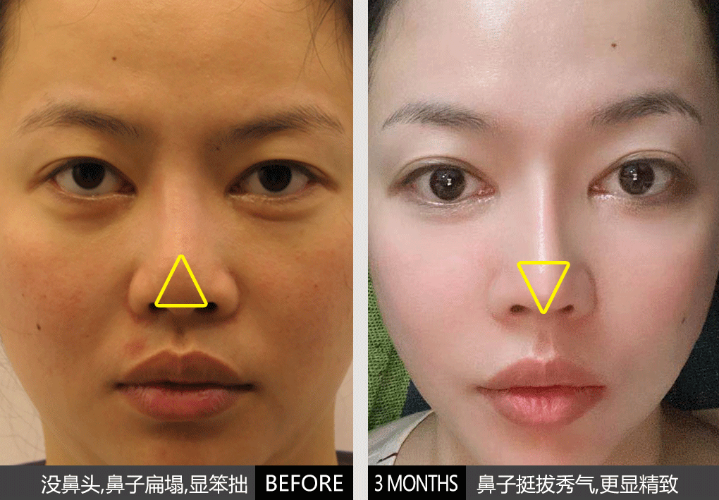 从"没鼻尖"到"有鼻尖",会带来怎样的改变?