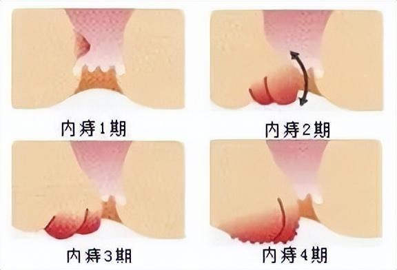 「豫健科普」对号入座了解内痔的4个发展时期