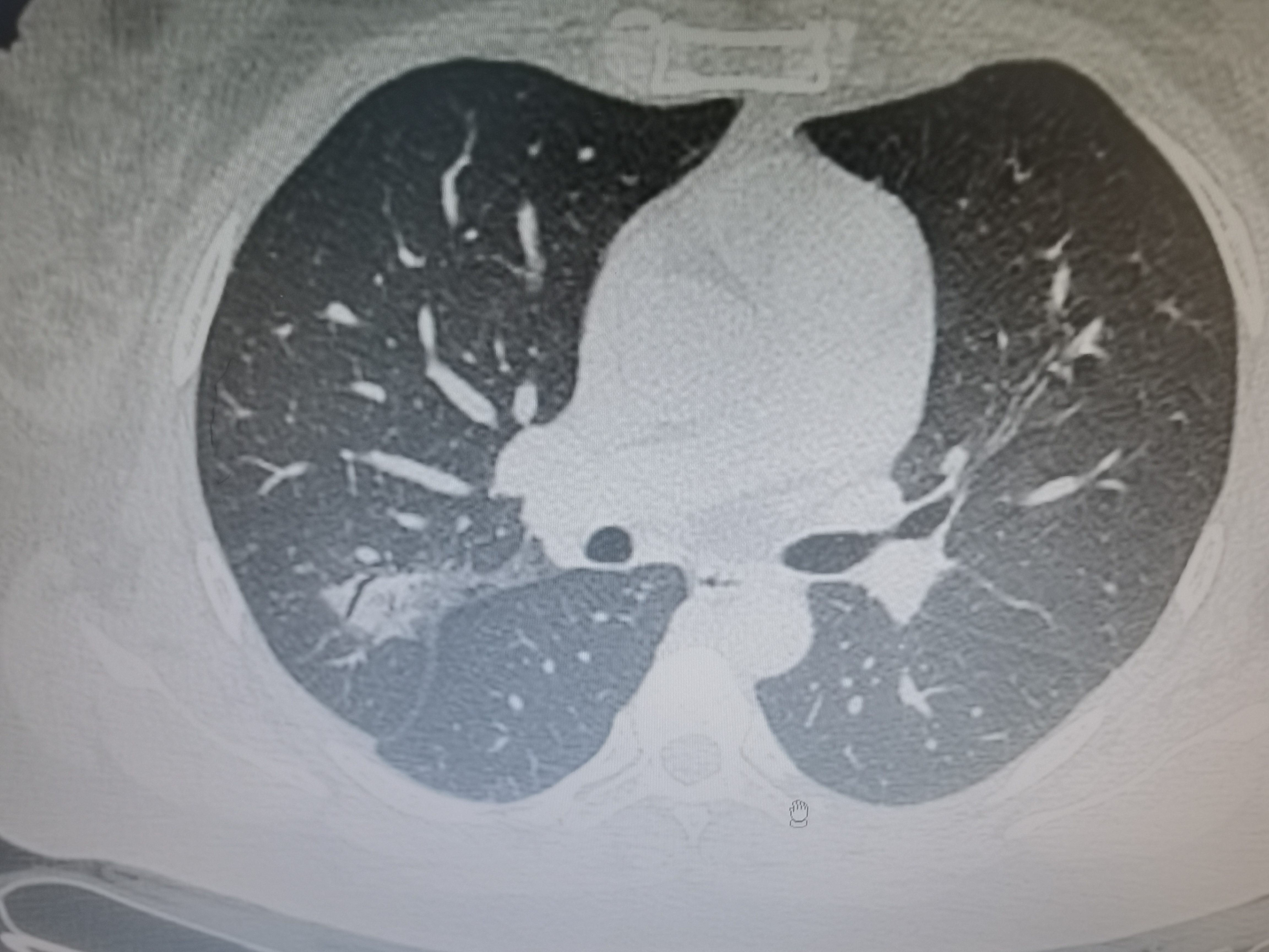 肺粘液腺癌,是一种会伪装成"肺炎"和"良性结节"的癌细胞!