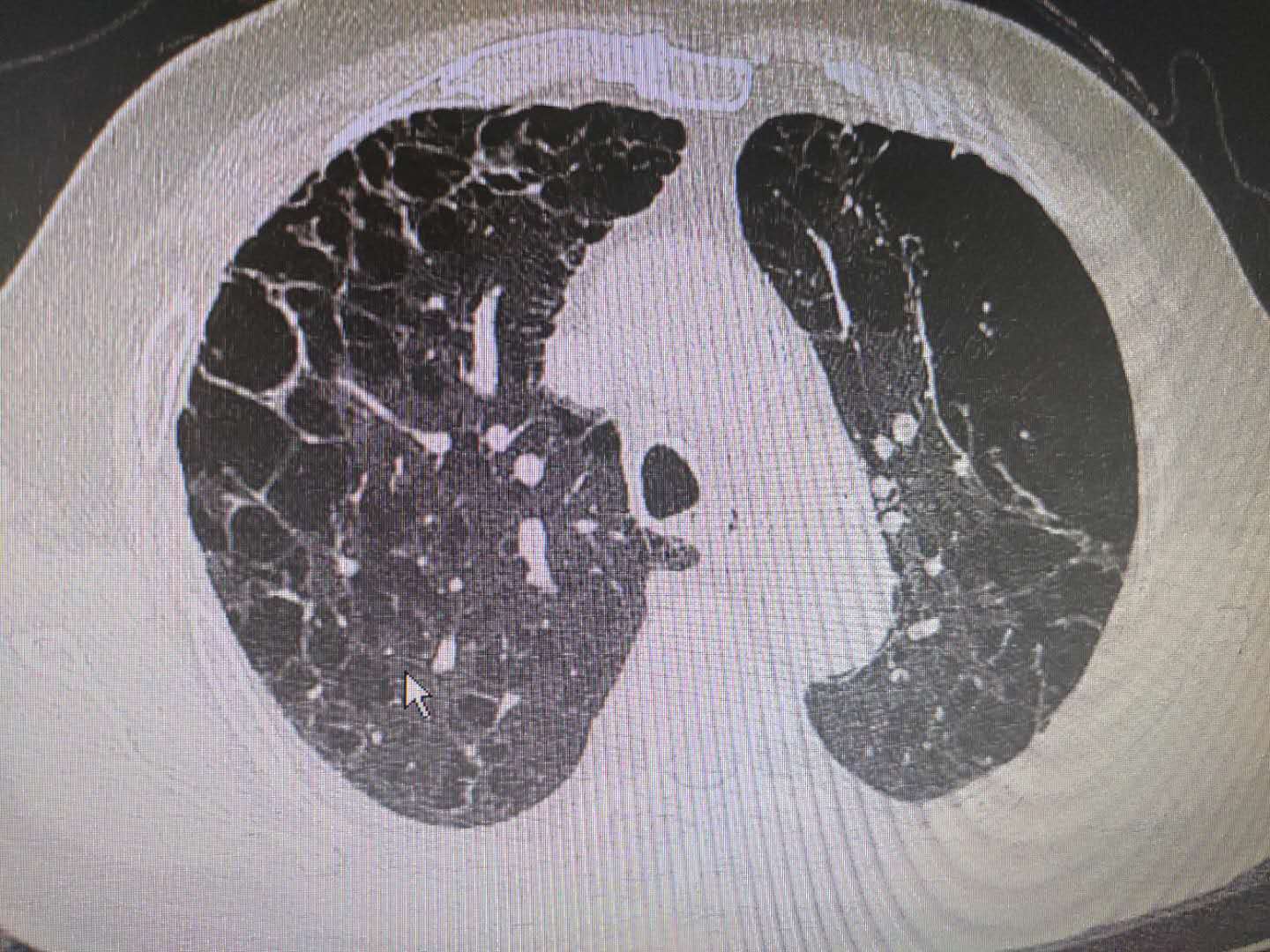 肺大泡ct图片 肺大疱图片