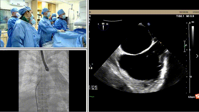 经典病例周周谈丨一例功能性二尖瓣反流经导管缘对缘修复分享