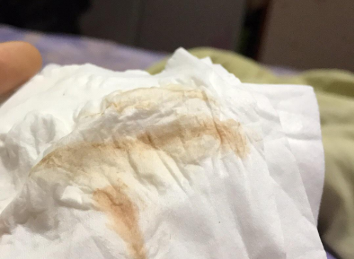 25岁女子经血流不干净,只因患宫颈癌,医生: