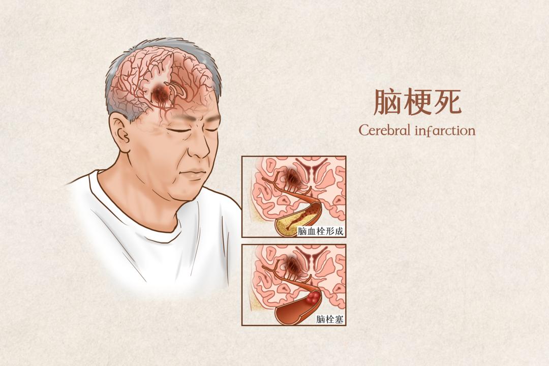 脑梗走路诀窍图片