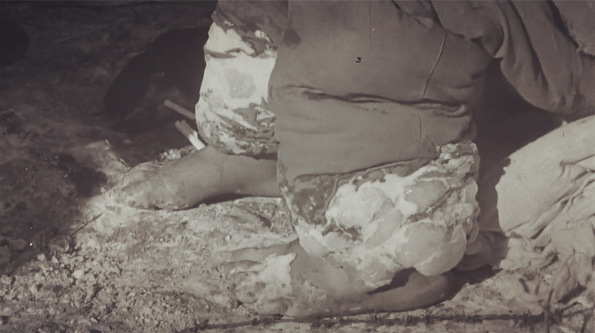 被冻伤士兵的脚