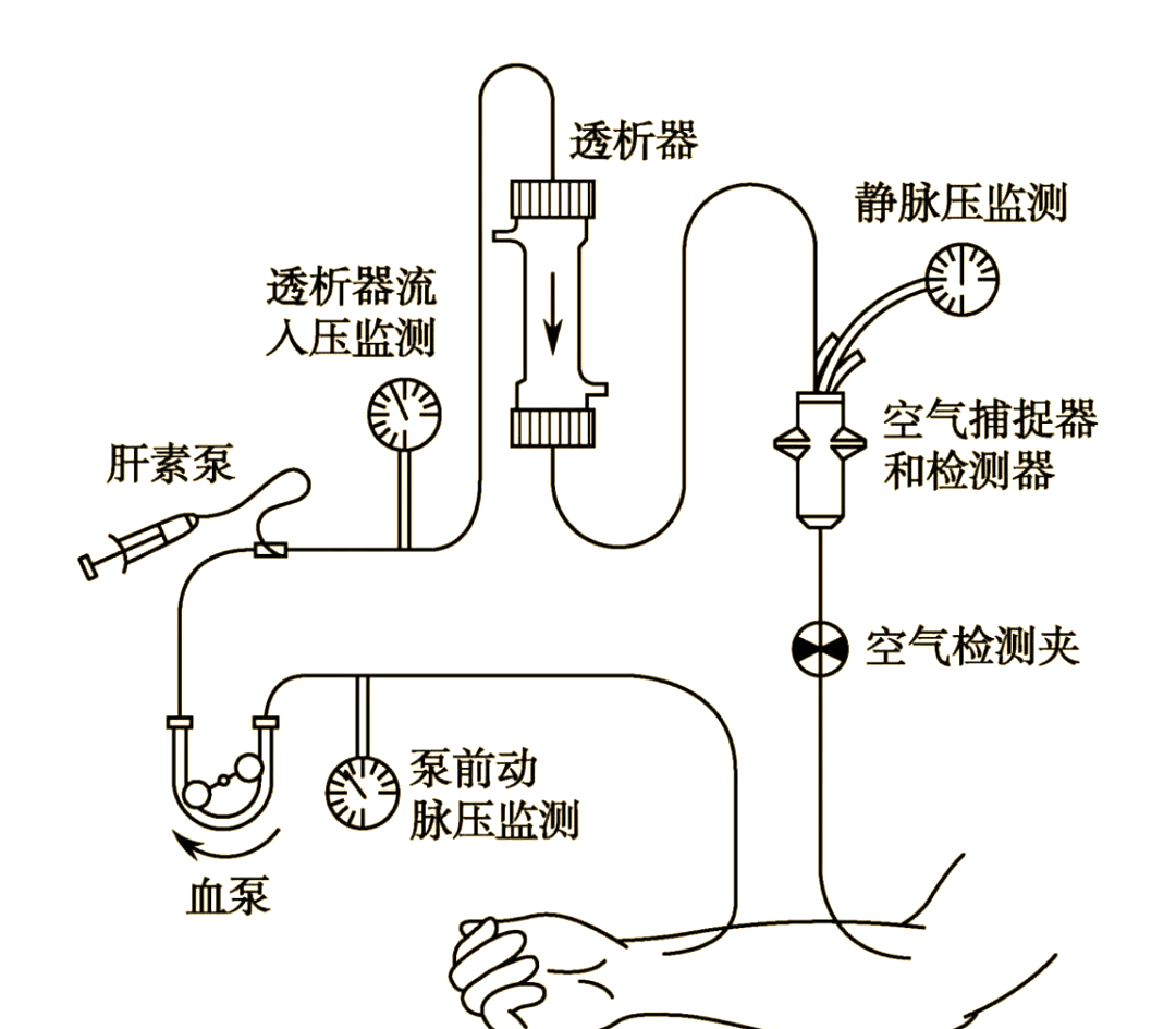 体外循环扮演着至关重要的角色,它涵盖了动脉血路,透析器以及静脉血路