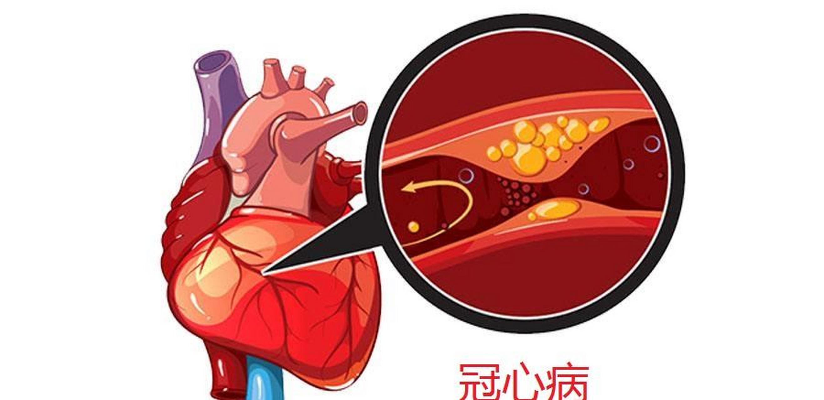 冠心病图片 真实图片