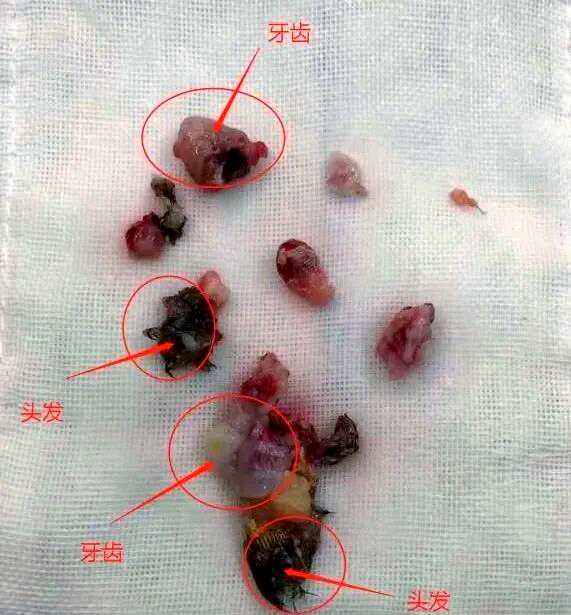 男孩脑袋里的畸胎瘤:手术奇迹与健康启示