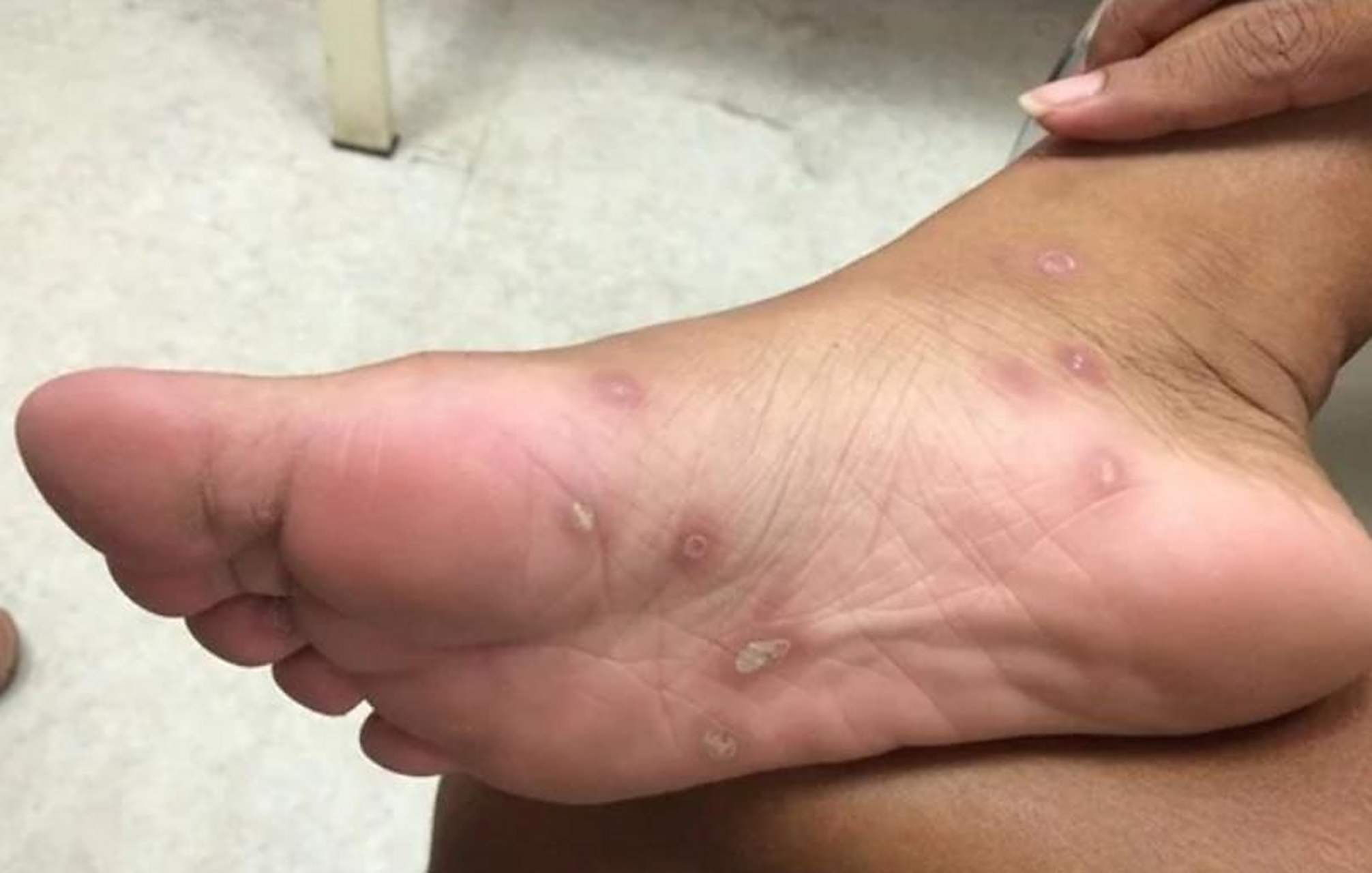 简单来说,梅毒疹通常为红色或灰色圆形疹子,大小不一,很像各种甜点上