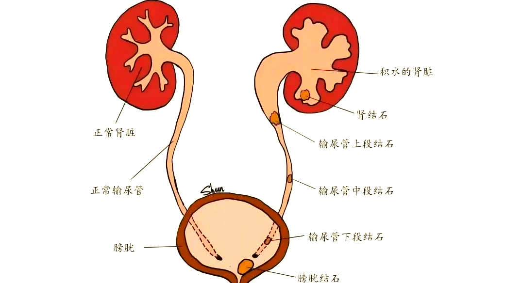 随着肾内尿液的增多和压力的上升,肾盂与肾盏会逐渐扩大,导致肾实质
