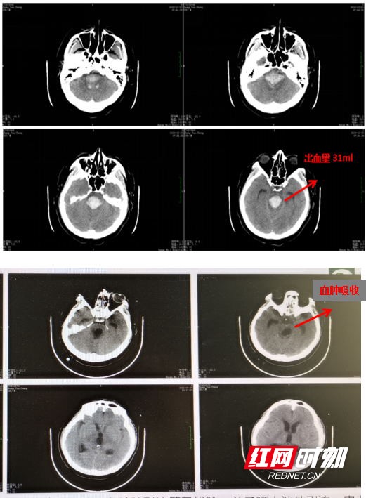 33岁男子脑出血命悬一线,医生勇闯"生命禁区"成功救治