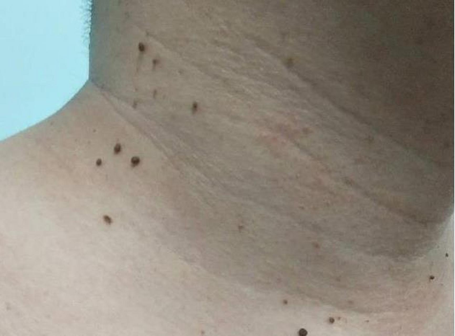 女子染hpv病毒脖子长"小肉疙瘩"#  近日,福州的陈女士不小心感染了