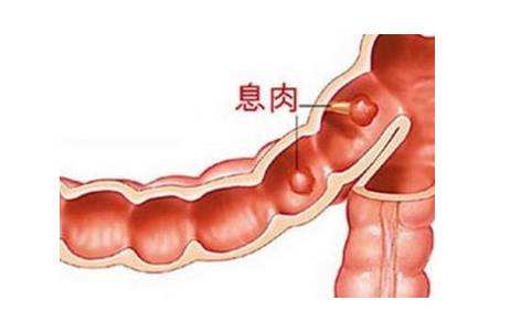 直肠息肉和痔疮的区别