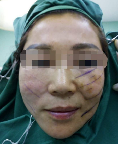 线雕一个月脸上有凹陷怎么办,脸部线雕40天还肿