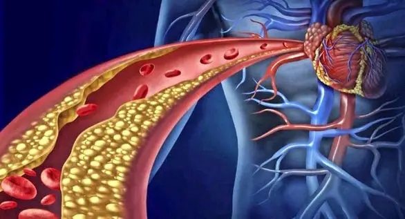 "降血脂疫苗"到底是什么?