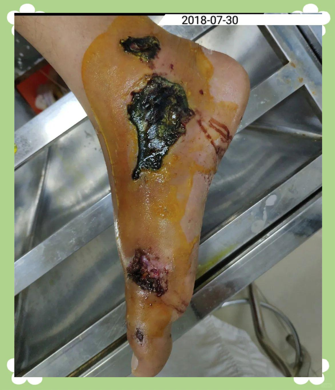 踝关节挫擦伤黑痂自溶性清创,仅换药3次即愈合