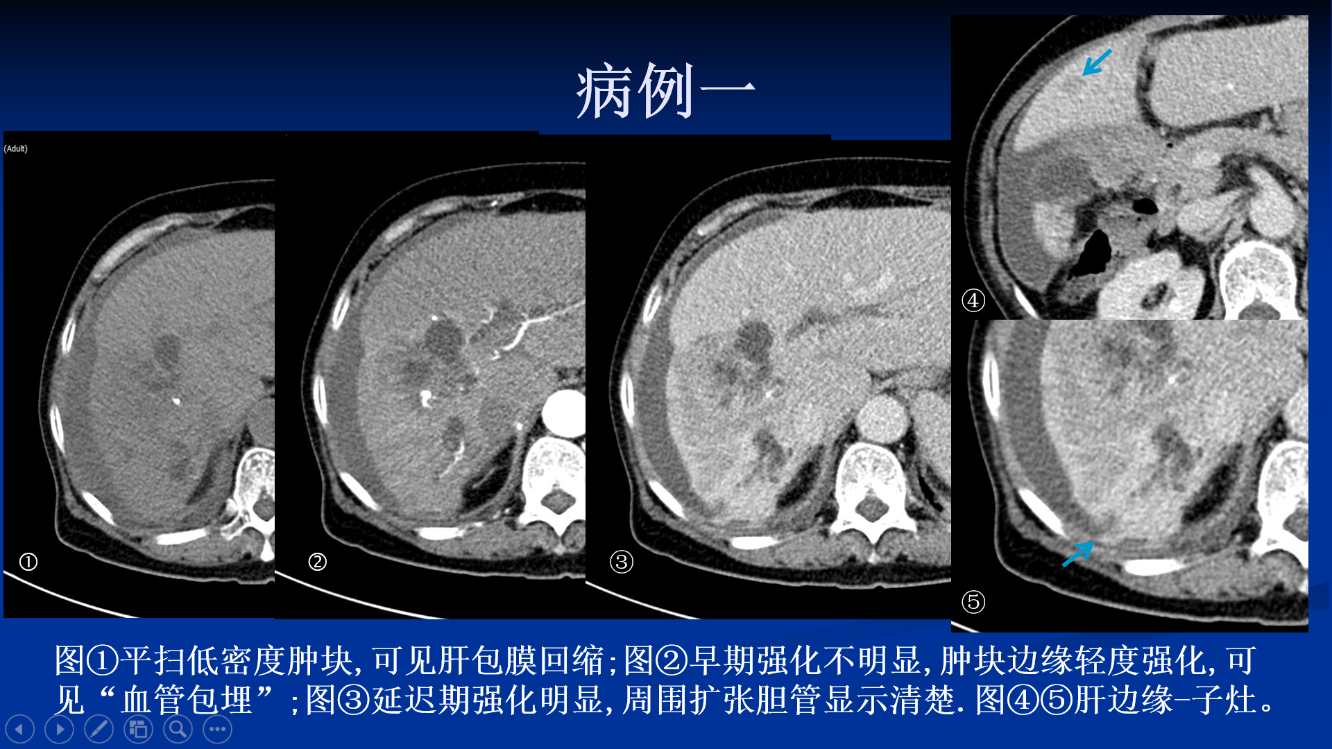 肝内胆管细胞癌图片