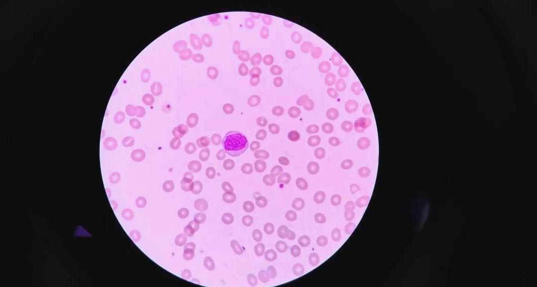 原幼单核细胞形态与诊断之间的微观探索