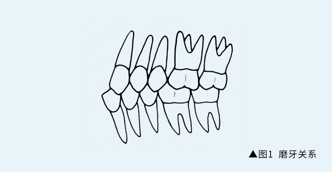 正畸科普 andrews的正常(牙合)六项标准