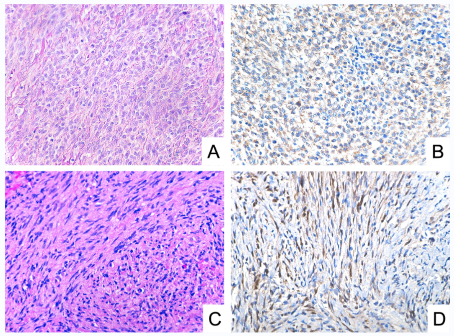 文献速递-foxo1可用于横纹肌肉瘤的分类