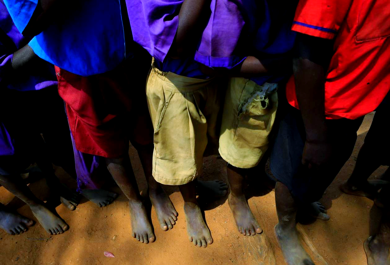 沙蚤通过人体脚底侵入后产卵,导致患者双脚严重溃烂,甚至可能致命