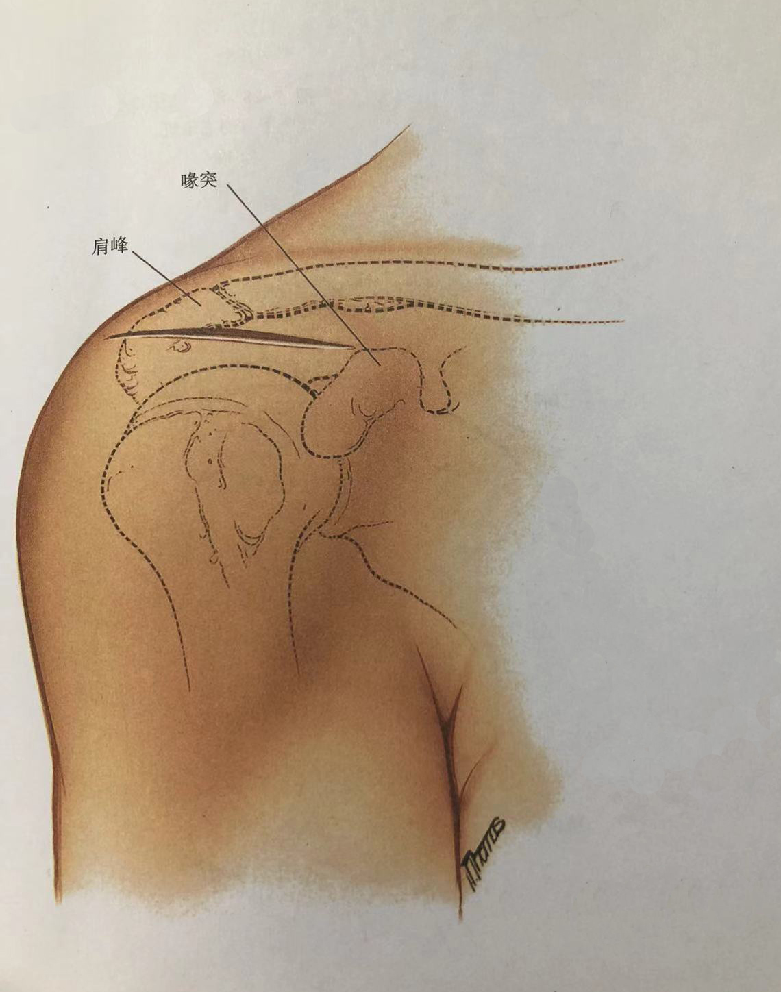 肩关节入路图解图片