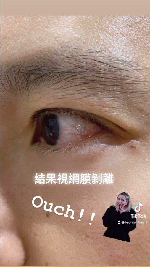 视网膜脱落能治好吗图片