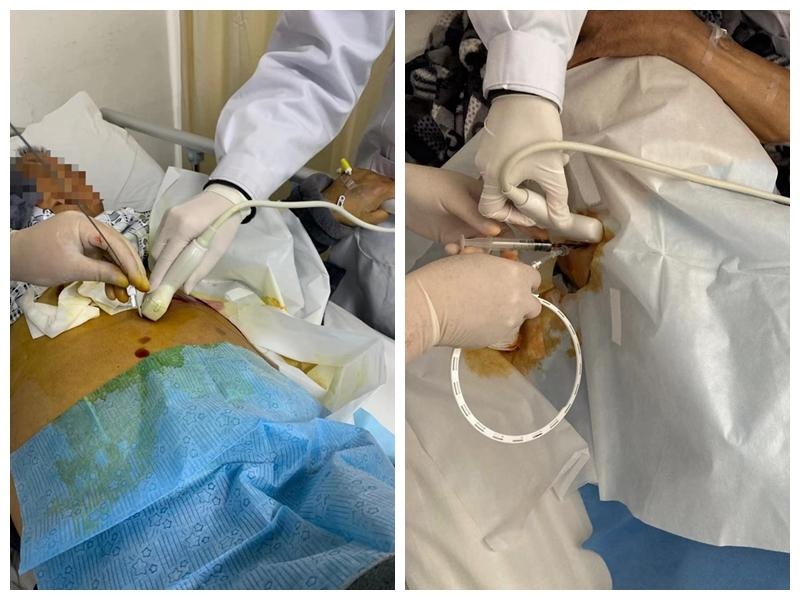 普六科:行彩超引导下ptcd术 缓解患者胆道梗阻