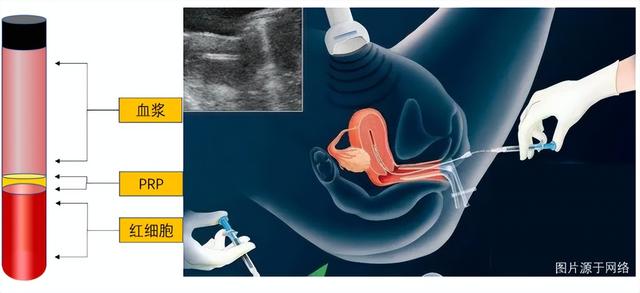 提高试管成功率新招,自体富血小板血浆宫腔灌注