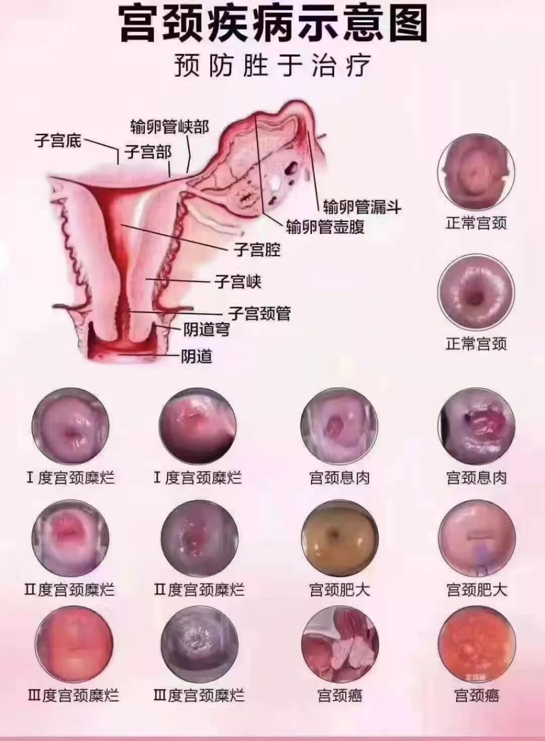 宫颈病变演变图图片