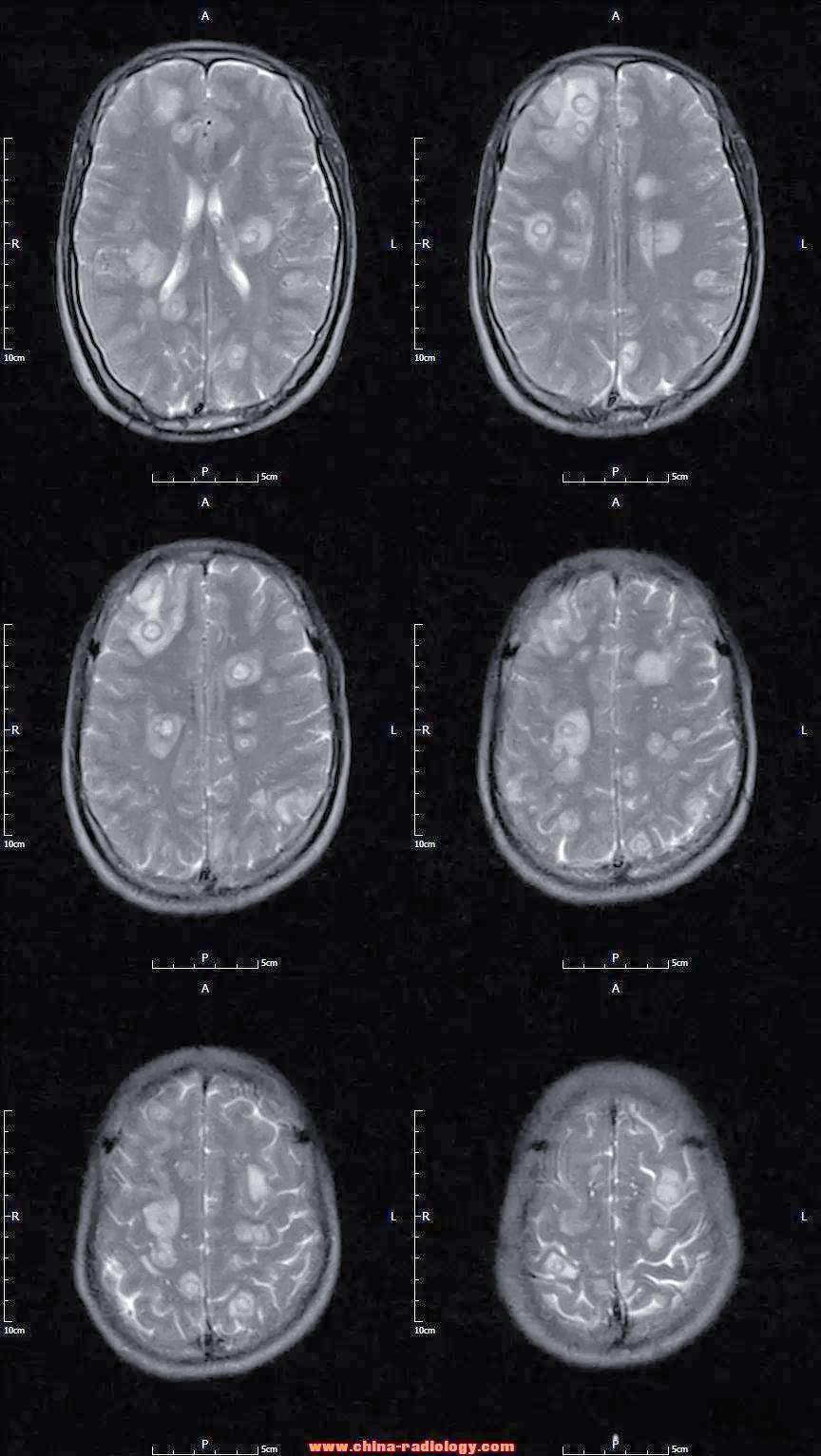 囊虫病:一种常见的中枢神经系统寄生虫感染