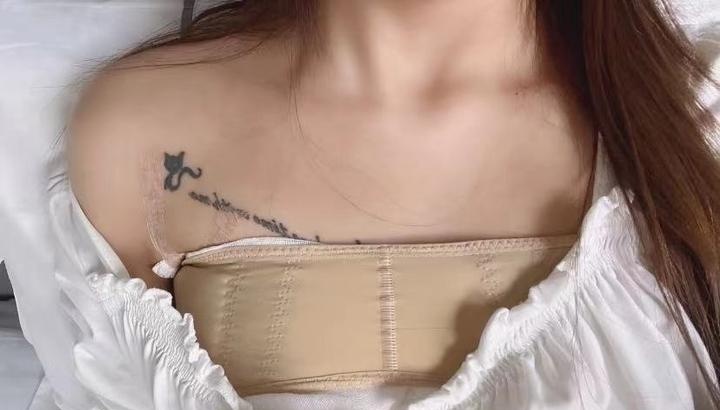 深圳姐妹做曼托圆形250高凸假体隆胸