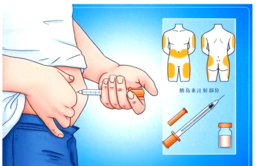 德谷门冬双胰岛素:成人糖尿病治疗的灵活选择与应用