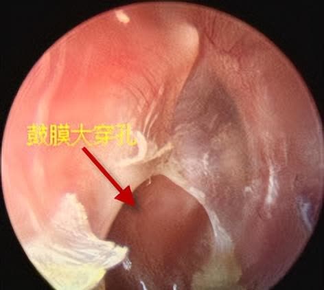 耳膜穿孔手术图片