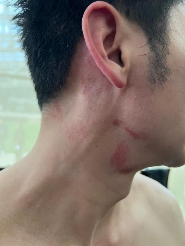 李晨脖子受伤被疑恋爱,工作室发声否认!其实他不是第一次受伤了