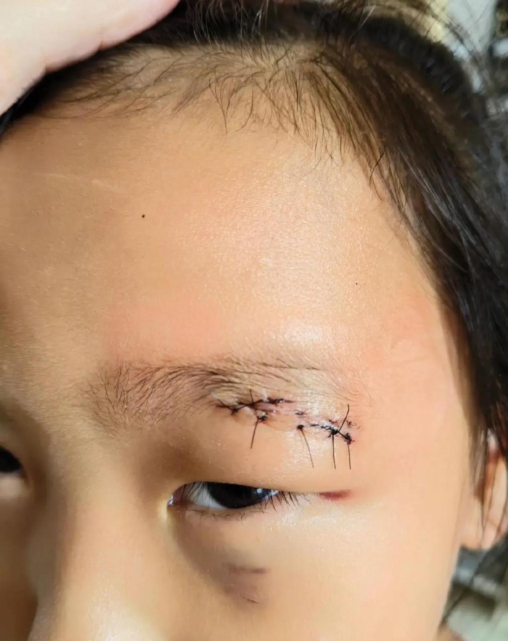 了5针,双方家长碰面,对方家长赔付了医药费,医院花了缝针费用150几块