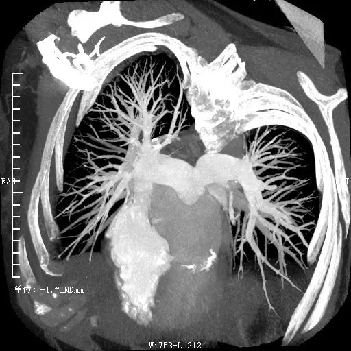 【小康说影像】肺动脉cta检测技术