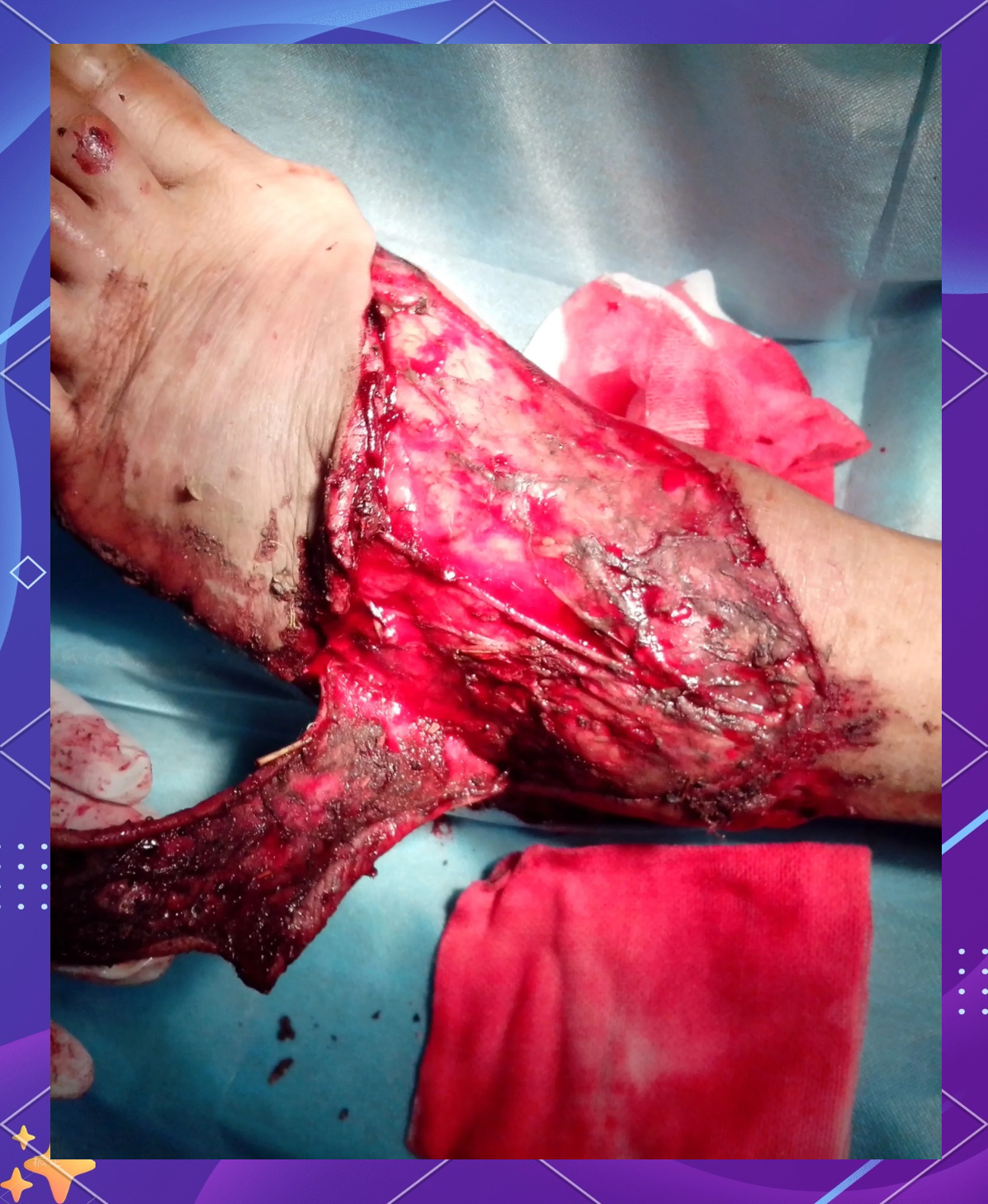 脚背受伤严重,犹如"扒皮"之痛,文字描述都令人心惊!