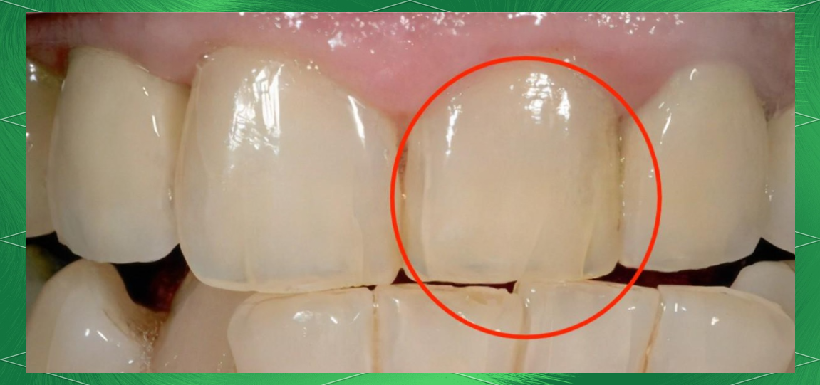 牙齿上的裂纹不容忽视!