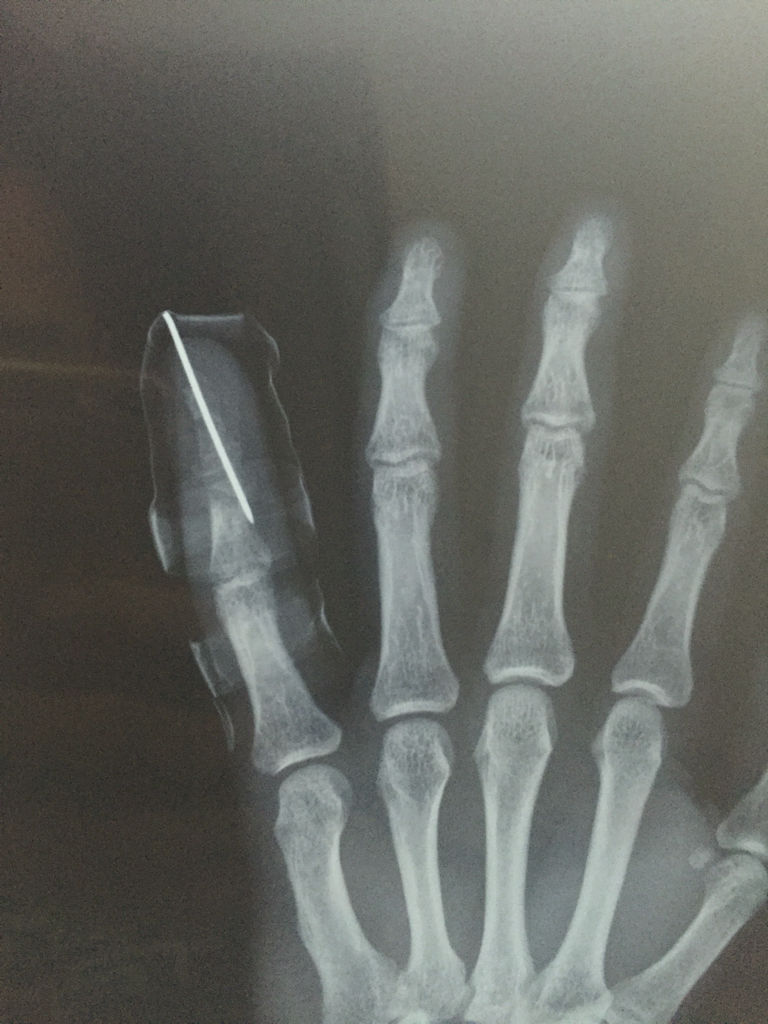 深圳律师│左手小指开放性骨折工伤能评几级伤残