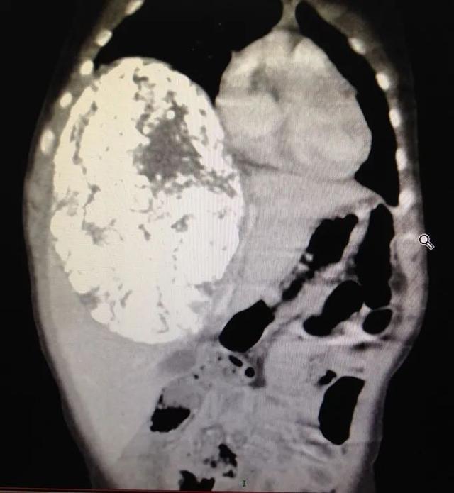 首儿医典肝母细胞瘤