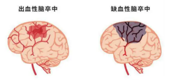 图解丨出血性脑卒中vs缺血性脑卒中