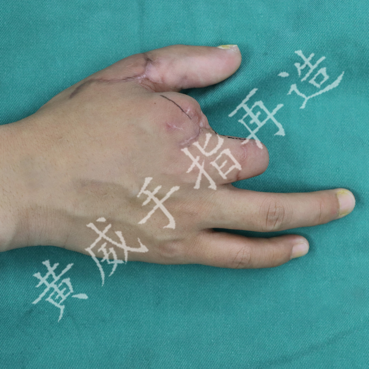 有手指再造术吗?失去的手指可以再造出来吗?