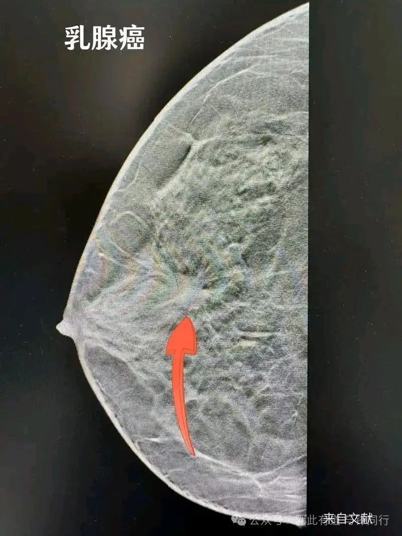 乳腺钼靶报告的几个核心点