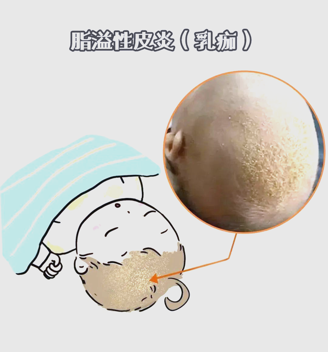 乳痂:宝宝头皮的保护神还是潜在的健康隐患?