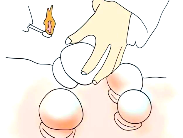 中医拔罐技术:探索多样化的特色疗法