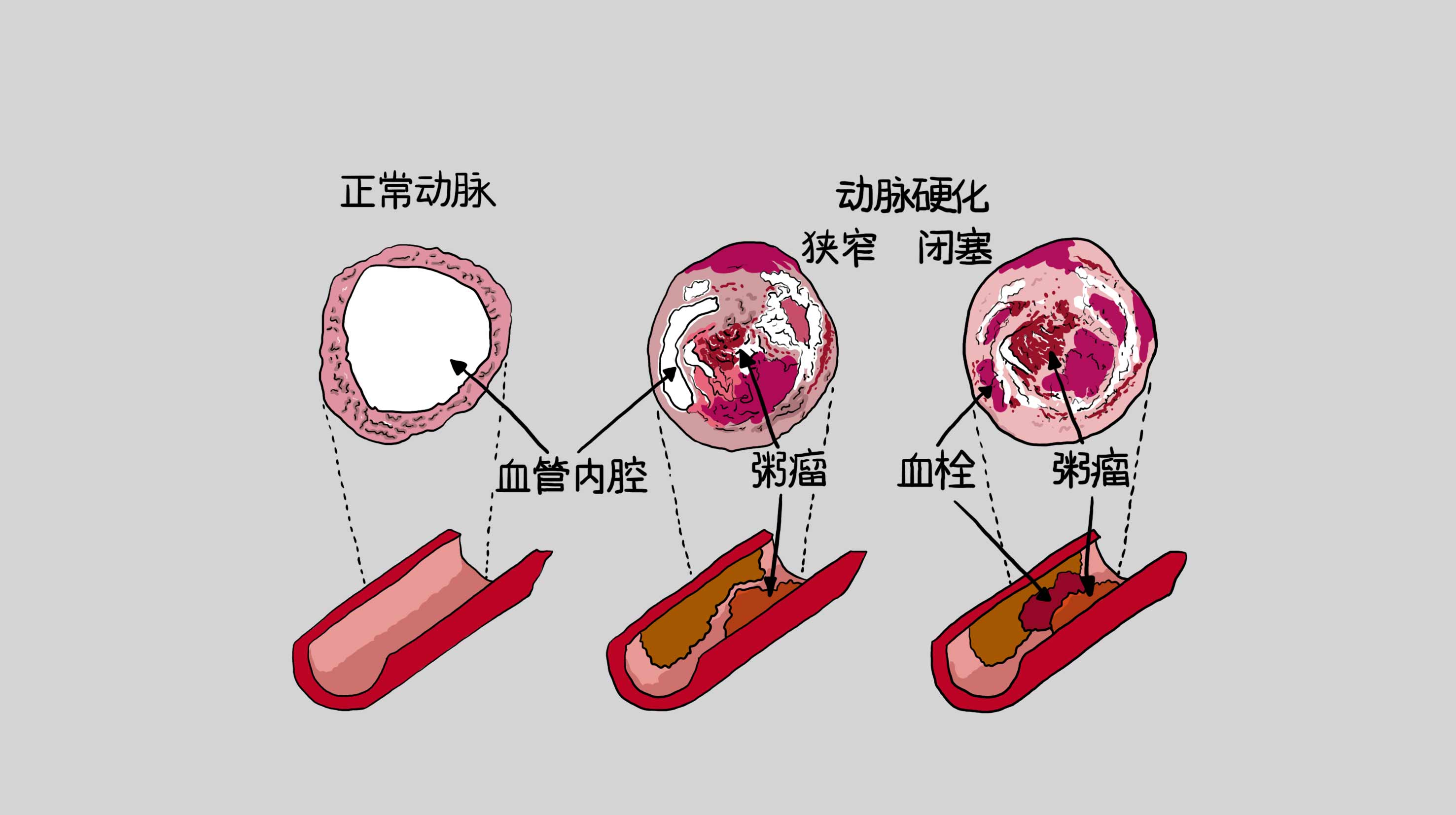 冠心病分类图片图片