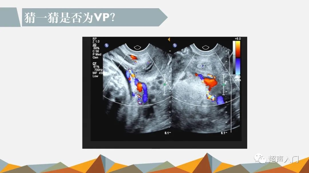 前置血管超声诊断思路