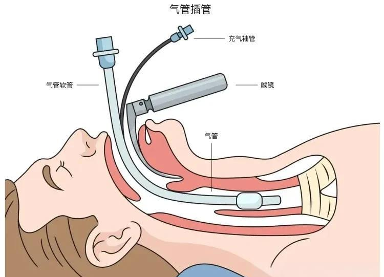 气管插管在紧急医疗情况中应用的关键细节